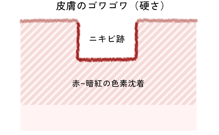 ニキビ跡のクレーター鍼