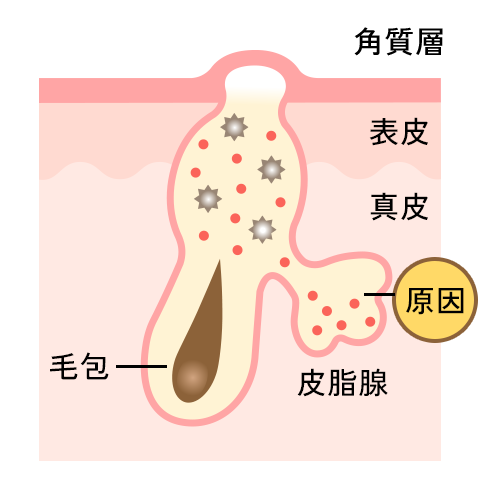 皮脂腺の過剰分泌