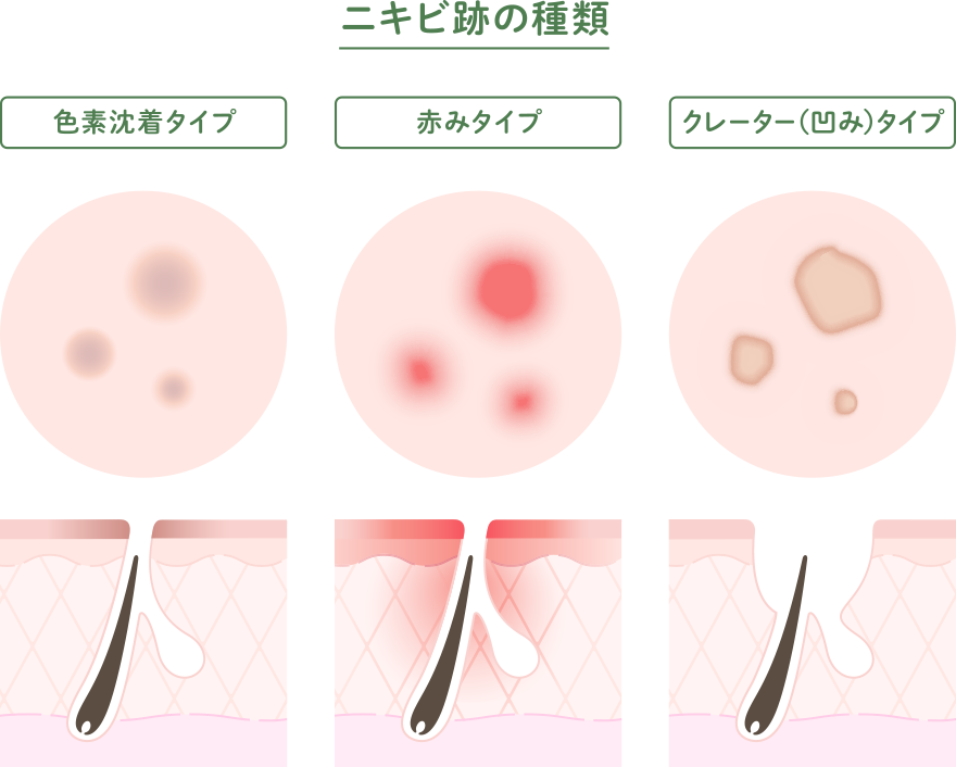 ニキビ跡 種類