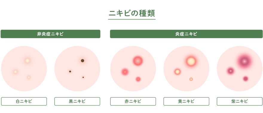 ニキビの種類